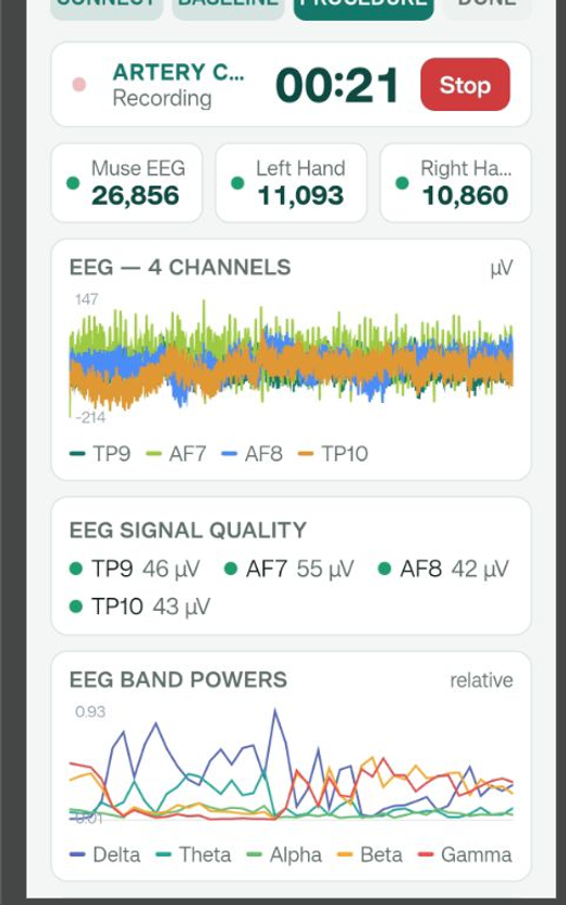 The mobile capture app — live EEG and dual-hand motion during a session.